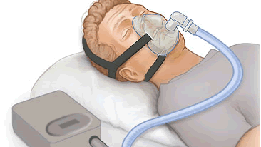 CPAP