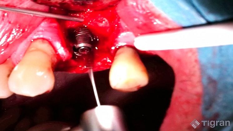 Implant debridement with Tigran PeriBrush