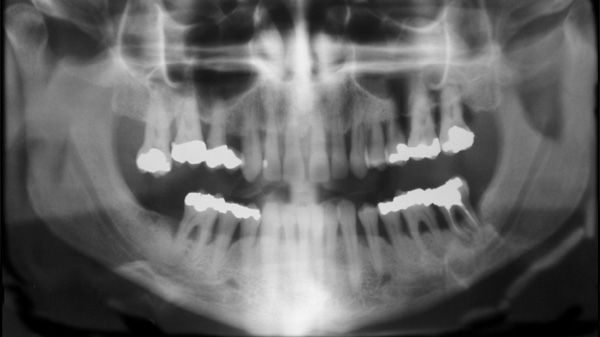 ​Kan tandlossning och ledgångsreumatism hänga ihop?