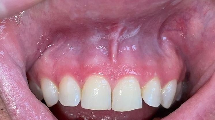 Bild 2b tandläkare efter snuslesion grad 1.jpg