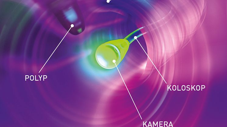 Polyp Darmspiegelung/Koloskopie. BESCHRIFTET