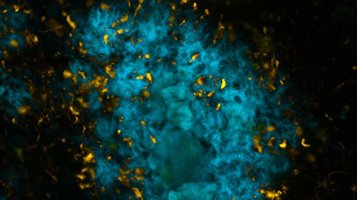 Hjärnvävnad med Alzheimerspatologi som färgats med en av de nya tau-specifika molekylerna (orange) och en av LiU-forskarnas tidigare molekyler (blått). Bilden är tagen i ett fluorescensmikroskop. Foto: Peter R Nilsson