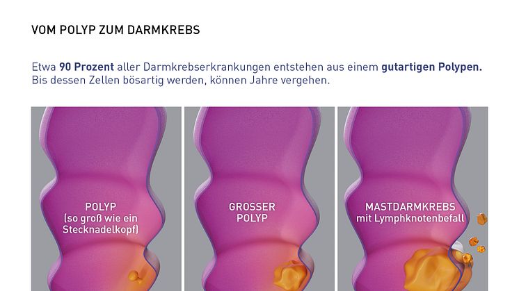 Grafische Darstellung des Wachstums vom Polyp zum Darmkrebs