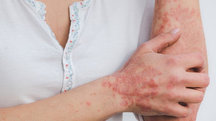 Kan medicin mot psoriasis hjälpa patienter med nydiagnostiserad typ 1-diabetes? Foto: pixabay