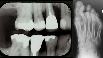 Inflammationsdriven benförlust synlig i röntgenbilder vid tandlossningssjukdom och ledsjukdomen reumatoid artrit. Foto: Elin Kindstedt.