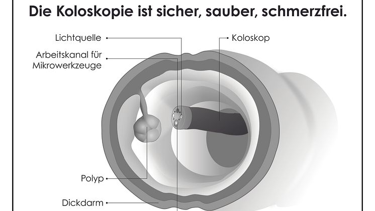 Nur bei der Darmspiegelung können Vorstufen von Darmkrebs entdeckt und gleich entfernt werden. 