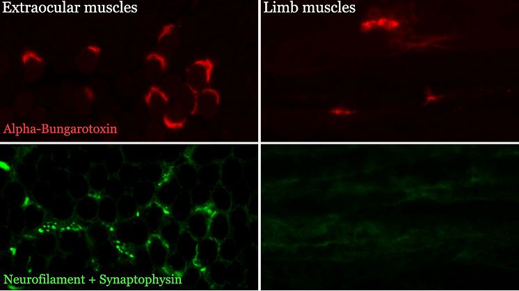 Neuromuskulära synapser i en ögonmuskel (vänster kolumn) och en benmuskel (höger kolumn) vid ALS. Kontakten mellan nerv (grön) och muskelfiber (röd) är bibehållen i ögonmuskeln medan kontakten bryts och försvinner i benmuskeln. Bild: Anton Tjust.