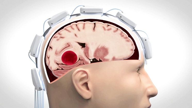 Så skiljer Strokefinder hjärnblödning från blodpropp