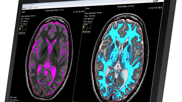 Sahlgrenska Universitetssjukhuset investerar i SyMRI®