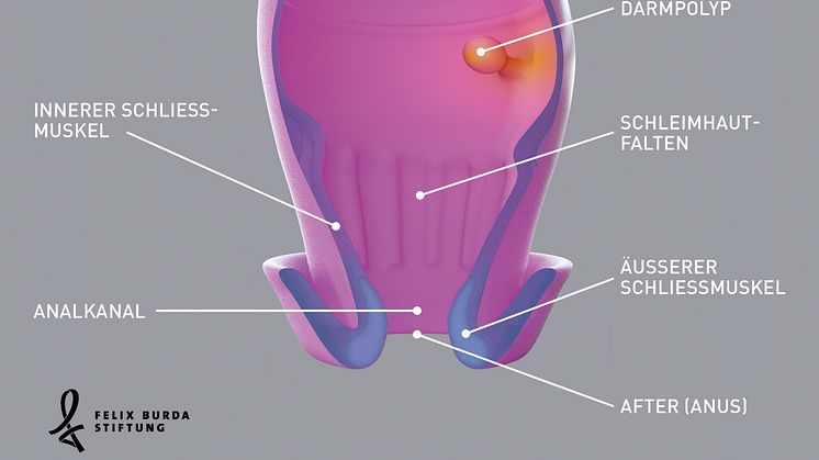 Anfangs ganz harmlos: Ein Darmpolyp