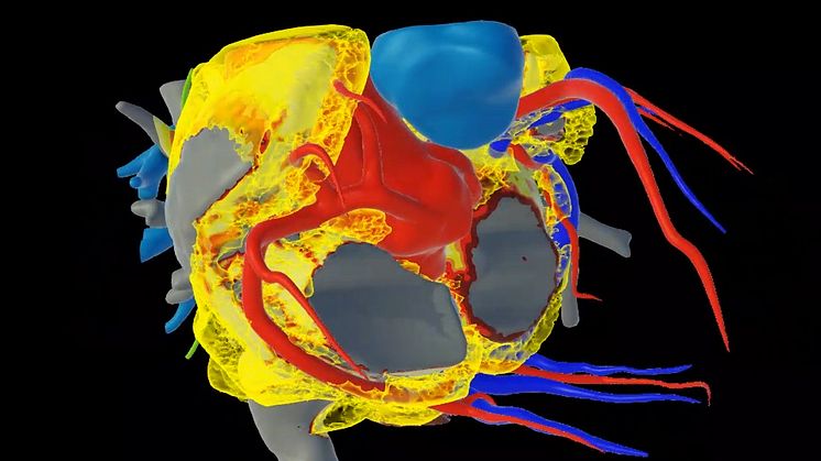 Die 3D-Bildgebung machts möglich: Blick auf ein Herz mit massivem Herzfettgewebe-Anteil.