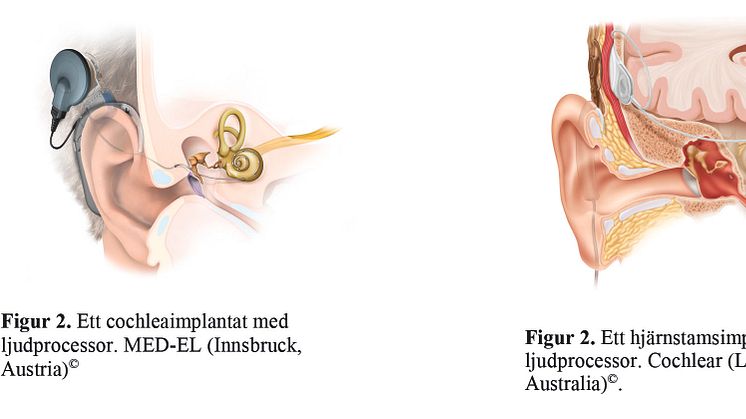 Cochleaimplantat och ABI-implantat