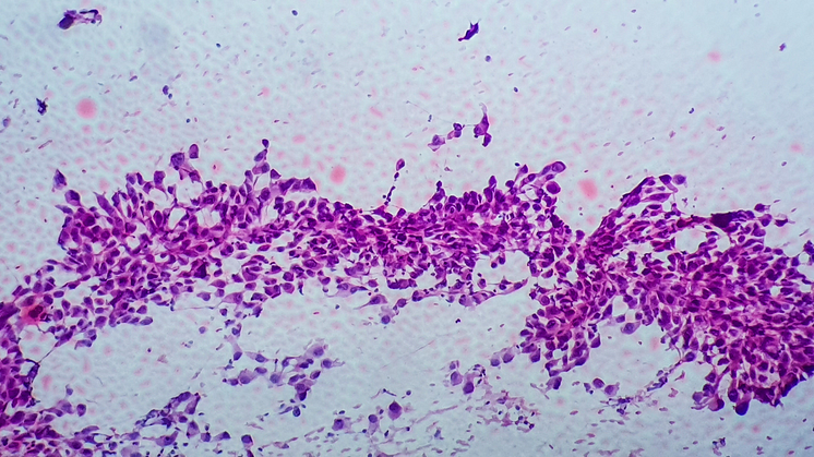 Första målinriktade behandlingen av icke-småcellig lungcancer med METex14-mutationer godkänd i Sverige