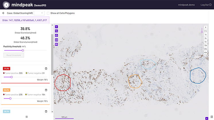 Here at Unilabs, we have joined forces with Mindpeak GmbH's AI in the fight against BreastCancer with the aim of decreasing manual work of pathologists by 80% or more per case.