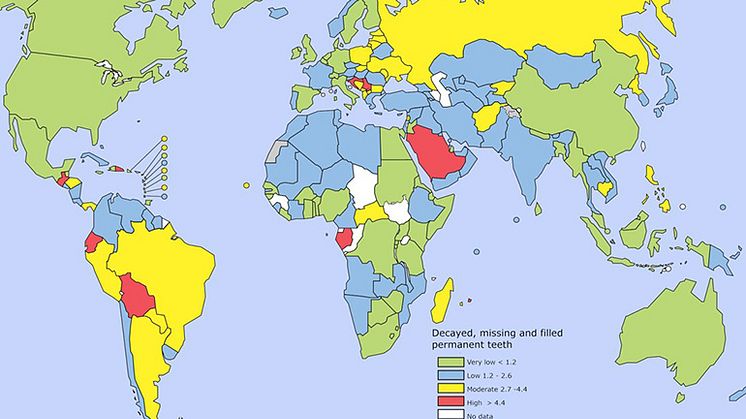 Databasen har statistik över global tandhälsodata från 207 länder och områden. 12-åringar har i snitt karies i två tänder.