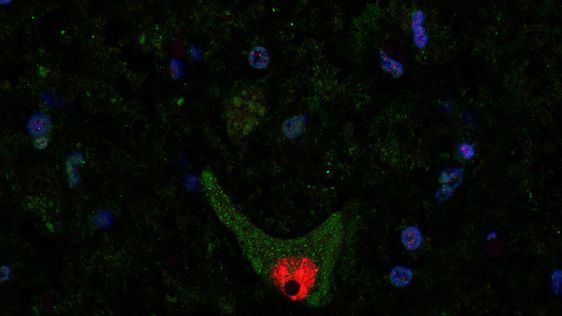Klumpar av felveckat protein i nervceller kan orsaka nervsjukdomen ALS