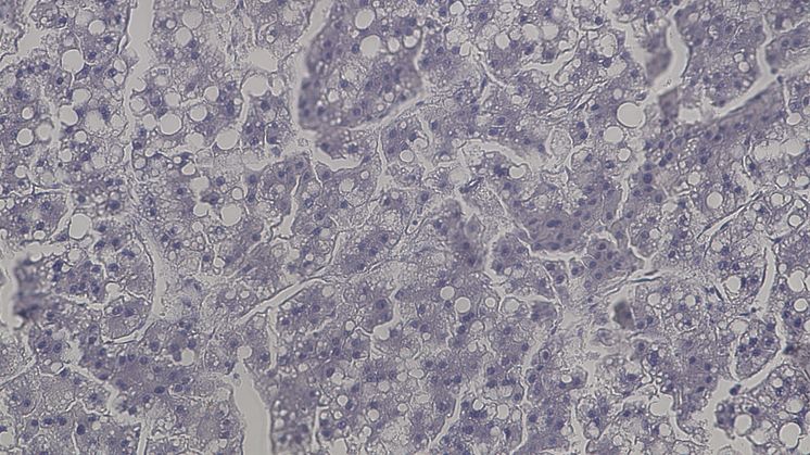 Epithelial cancer cells