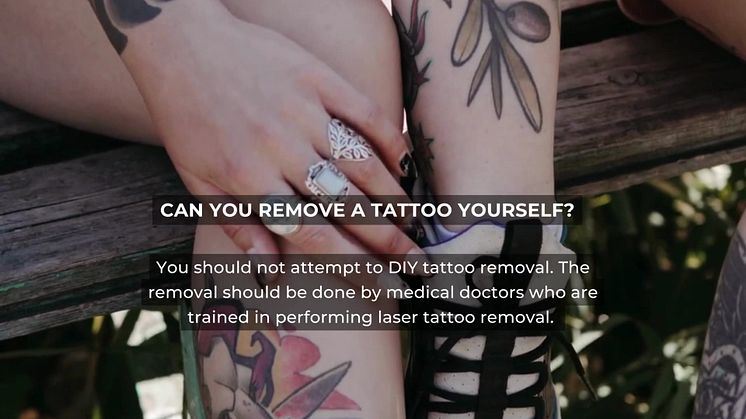 Common questions during tattoo laser removal consultation