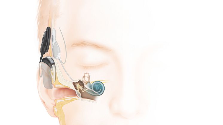 Wie das Hören mit einem Cochlea-Implantat (hinter dem Ohr) funktioniert