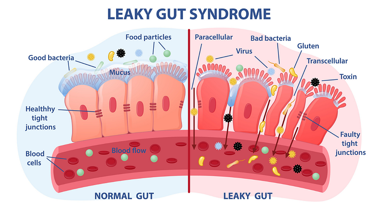 theorie_lipoedem_durch_leaky_gut_syndrom_beguenstigt