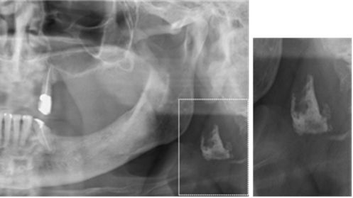 Panoramaröntgenbild på tänder och käkar som visar uttalade karotisförkalkningar på båda sidor av halsen (till höger och vänster). Foto: Maria Garoff. 