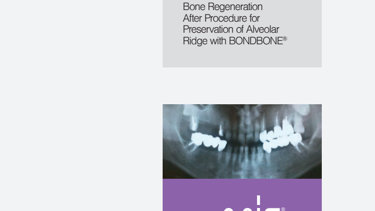 Bone Regeneration After Procedure For Preservation of Alveolar Ridge With BONDBONE®