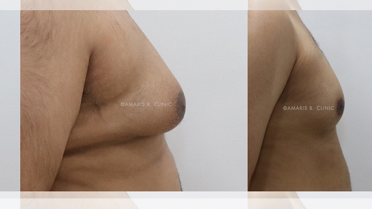 How do I know if I have Gynecomastia or Pseudogynecomastia?