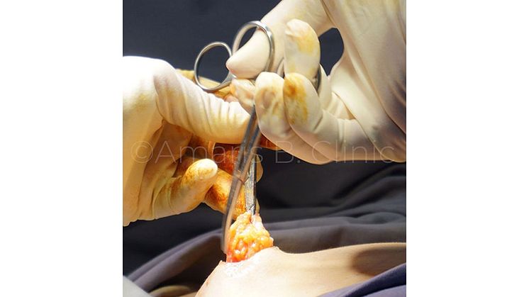 Can You Correct A Botched Gynecomastia Surgery?