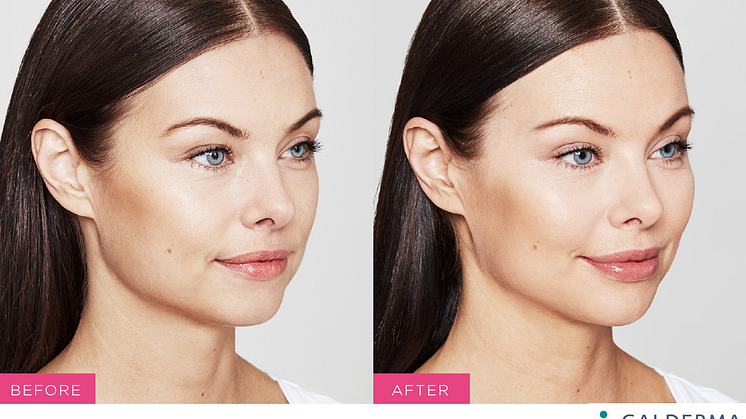 Before and After Restylane® Kysse by Galderma