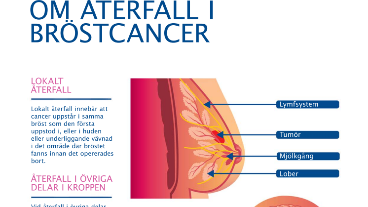 Återfall i bröstcancer - illustration