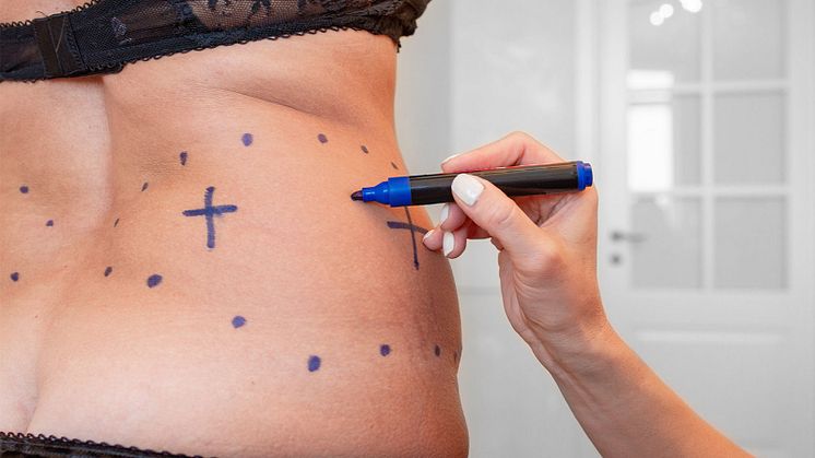 Is Liposuction Cheating?
