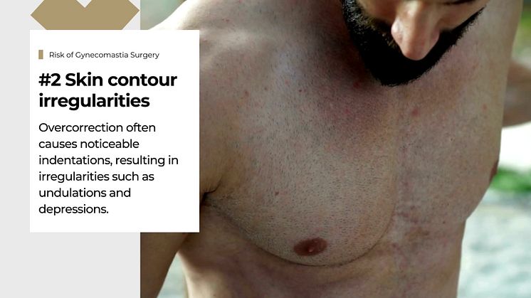 Risks & Complications of Gynecomastia Surgery | Amaris B. Clinic by Dr Ivan Puah