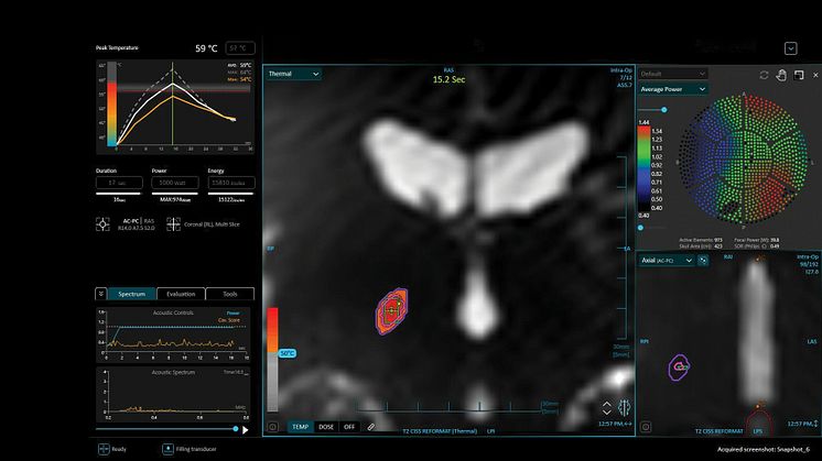 Insightec_Exablate_Prime_UI.jpg