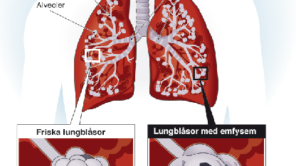 Fyra av fem KOL-drabbade saknar diagnos