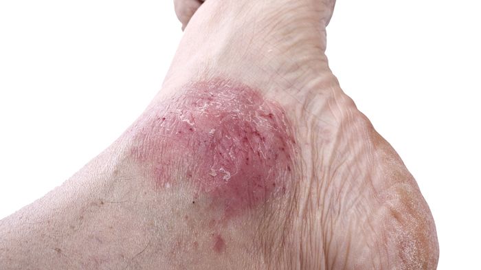 Oftmals liegen mehrere Jahre zwischen dem Auftreten einer Psoriasis (Schuppenflechte) und dem Hinzukommen der Psoriasis-Arthritis. Bild: Orlando Bellini | fotolia