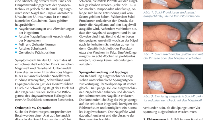 Spange statt Zange: Orthonyxie-Technik in der Behandlung eingewachsener Nägel