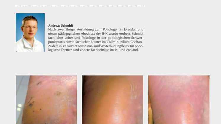 Erfahrung aus der Podologiepraxis: Rhagaden und Hyperkeratose am diabetischen Fuß