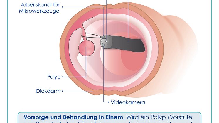 Nur bei der Darmspiegelung können Vorstufen von Darmkrebs entdeckt und gleich entfernt werden. 