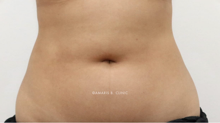 Body Parts & Conditions That Can Be Treated With Vaser Liposuction