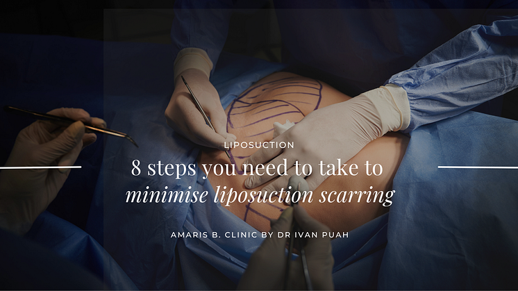 8 steps you need to take to minimise liposuction scarring