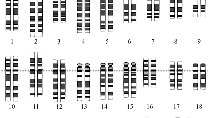 Downs syndrom karyotyp - från Wikimedia