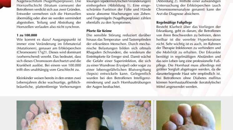 Palmoplantare Hyperkeratose: Das vererbte Leiden