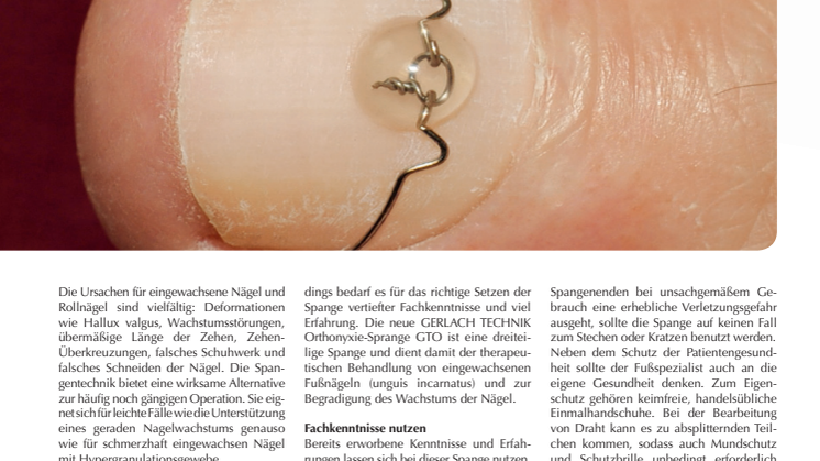 Spangentechnik mit der Orthonyxie-Spange GTO von GERLACH TECHNIK: Einfach, schnell und wirksam