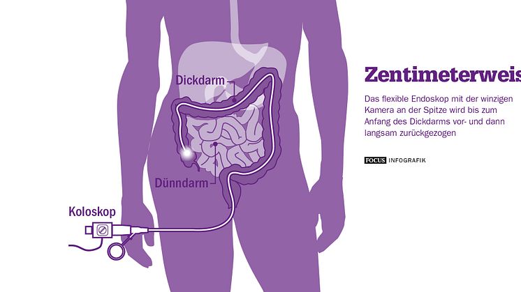 Zentimeterweise: Das Endoskop. FOCUS Infografik