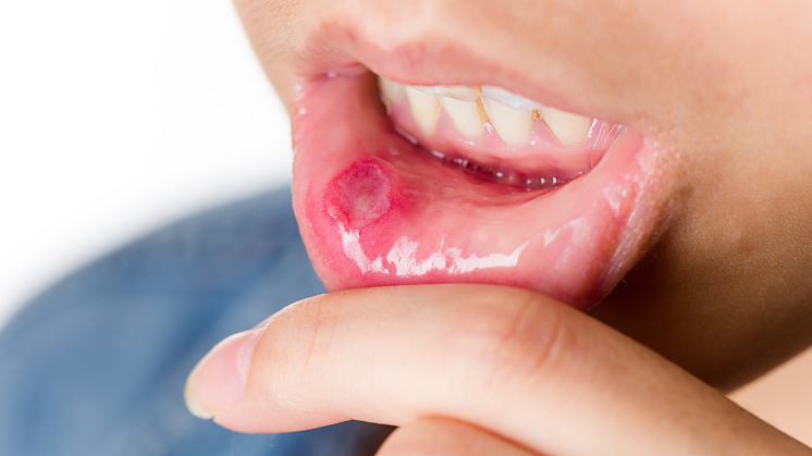 Recurrent aphthous stomatitis