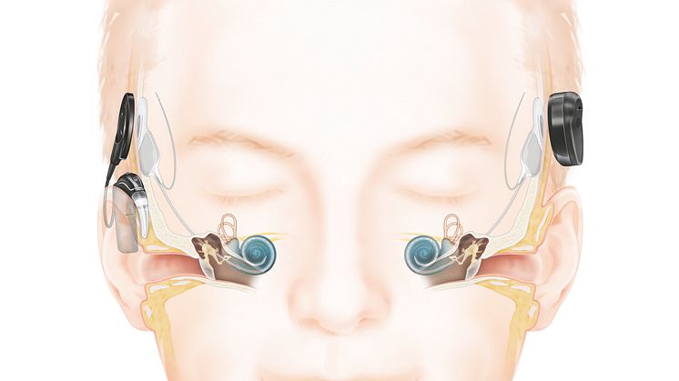 Wie das Hören mit einem Cochlea-Implantat funktioniert