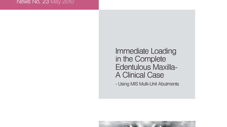 Immediate Loading in the Complete Edentolous Maxilla, A Clinical Case