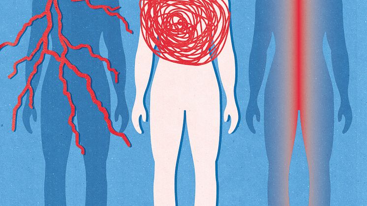 Lungsjukdomen sarkoidos. Illustration av Kotryna Zukauskaite 