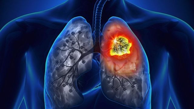 radon lung cancer
