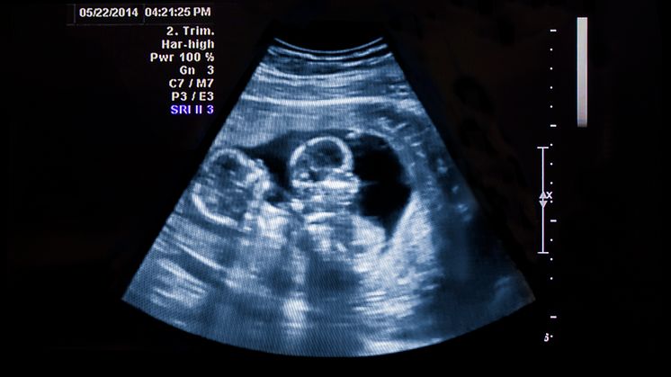 Fritt frem for å abortere bort frisk tvilling